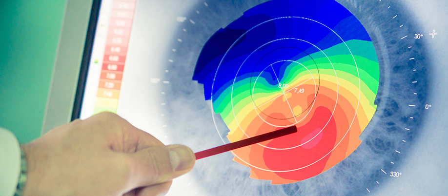 Cross-Linking For Conical Cornea 