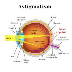 Astigmatism