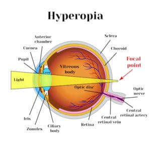 Farsightedness | Hyperopia
