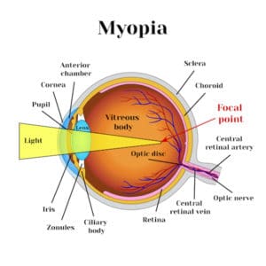 Nearsightedness | Myopia