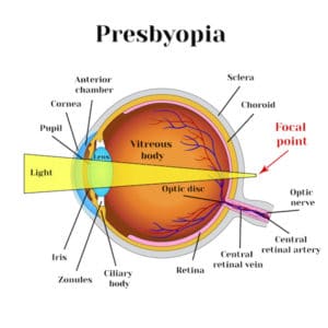 Presbyopia