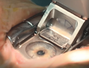 Ruiz, a Barraquer disciple, further develops Barraquer’s procedure by introducing a non-freeze technique called in-situ keratomileusis (the “I” in LASIK) to allow him to access the treatable area with a microkeratome (a mechanical lathe).