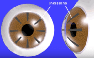 Svyatoslav Fyodorov, a Russian scientist, develops RK, a method of relaxing the cornea with cuts to change its shape.